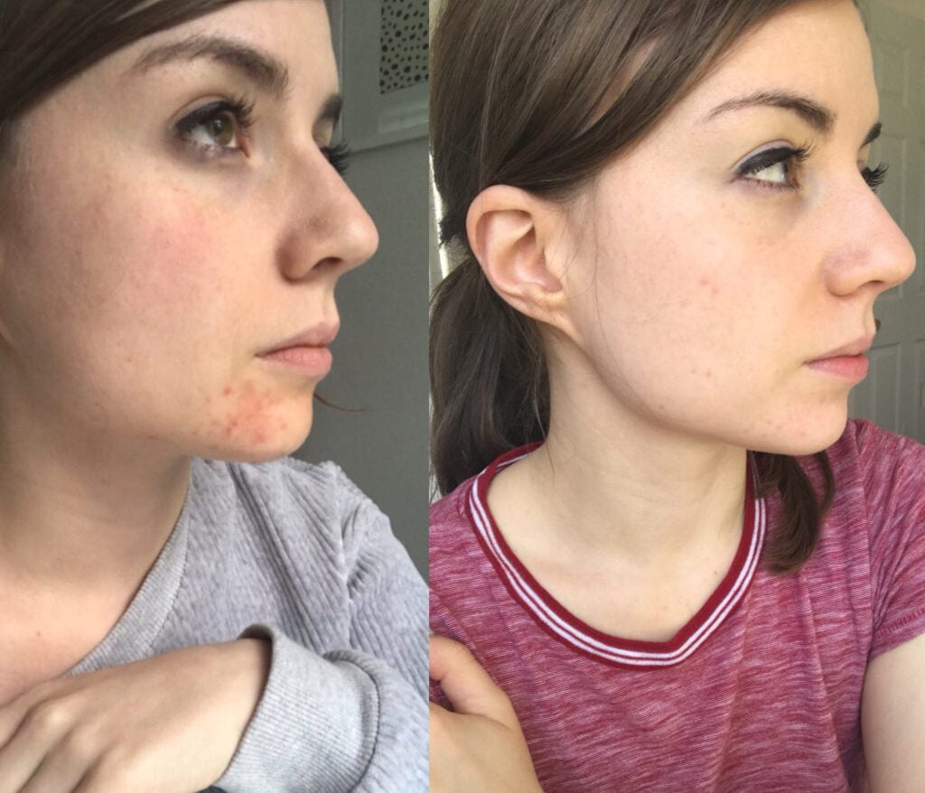 I Haven't Used My Acne Medication in Four Weeks: Here's What I've